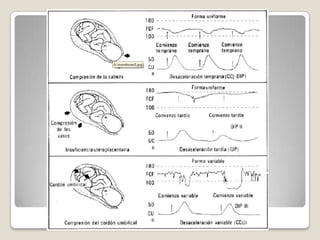 Monitoreo fetal + dips