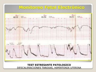 Monitoreo fetal + dips