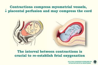 MONITOREO FETAL INTRAPARTO CONSENSO FIGO 2015.pptx