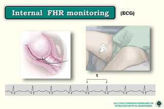 MONITOREO FETAL INTRAPARTO CONSENSO FIGO 2015.pptx