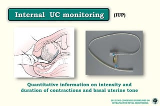 MONITOREO FETAL INTRAPARTO CONSENSO FIGO 2015.pptx
