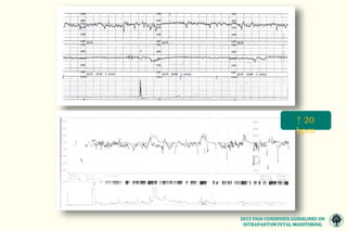 MONITOREO FETAL INTRAPARTO CONSENSO FIGO 2015.pptx