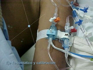Eje flebostático y calibración
 