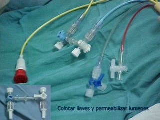 Colocar llaves y permeabilizar lumenes
 