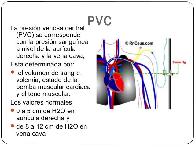 Cateterismo cardiaco