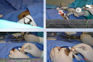 DOPPLER TRANSCRANEALBuena herramienta en el monitoreo continuo no invasivo del flujo sanguíneo cerebral durante el procedimiento anestésico. Permite al anestesiólogo determinar la habilidad del paciente para tolerar la hipotensión, evaluar el efecto de la hiperventilación y hacer eldiagnostico de vasoespasmo.