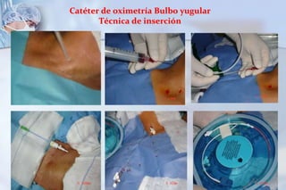   ELECCIONEVITARSUBTRATAMIENTO		Riesgo de HEC residualSOBRETRATAMIENTORiesgo de hipotensión intracraneana