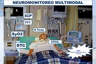 NEUROMONITOREO MULTIMODAL
ICP
B Temp
ETCO2
SyO2
PtiO2
(presión tisular de oxígeno
cerebral )
DTC
PPC
 