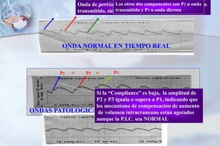 P1 > P2 > P3
Onda de percusión, representa el latido arterial sistolico
transmitido, siendo el más alto de los tres picos.-
Los otros dos componentes son P2 u onda
transmitida y P3 u onda dicrota
ONDA NORMAL EN TIEMPO REAL
P1 < P2 < P3
ONDA EN Tº
REAL
En tienda de
campañaONDAS PATOLOGICAS
Si la “Compliance” es baja, la amplitud de
P2 y P3 iguala o supera a P1, indicando que
los mecanismo de compensación de aumento
de volumen intracraneano están agotados
aunque la P.I.C. sea NORMAL
 