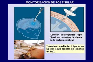 MONITORIZACION DE PO2 TISULAR
 