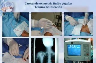 Catéter de oximetría Bulbo yugular
Técnica de inserción
 