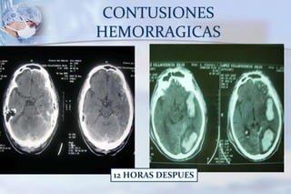 CONTUSIONES
HEMORRAGICAS
12 HORAS DESPUES
 
