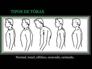 TIPOS DE TÓRAX
Normal, tonel, cifótico, escavado, carinado.
 
