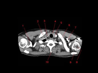 TC mediastino superior
 