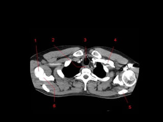 Monitoria mediastino