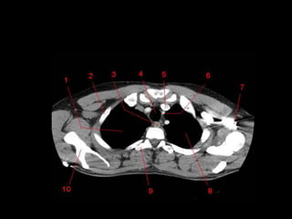 Monitoria mediastino