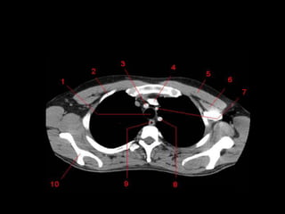 Monitoria mediastino