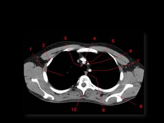 Monitoria mediastino