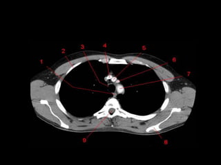Monitoria mediastino