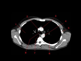 Monitoria mediastino