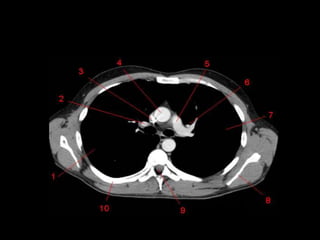 Monitoria mediastino