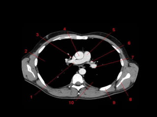 Monitoria mediastino
