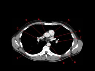 Monitoria mediastino