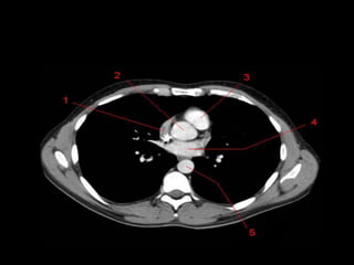 Monitoria mediastino