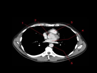 Monitoria mediastino