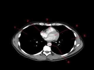 Monitoria mediastino