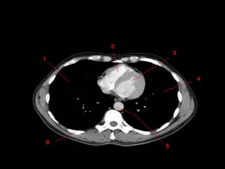 Monitoria mediastino