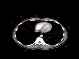 Monitoria mediastino