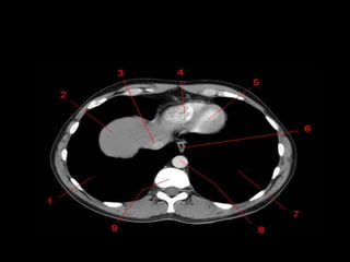 Monitoria mediastino