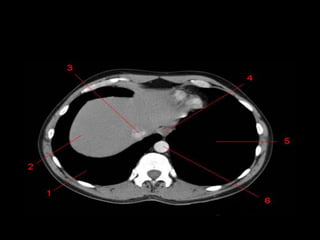 Monitoria mediastino
