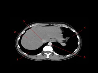 Monitoria mediastino