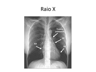 Raio X
 