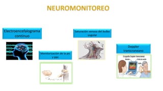 Electroencefalograma
continuo
Monitorización de la pic
y ppc
Saturación venosa del bulbo
yugular
Doppler
transcraneano
 