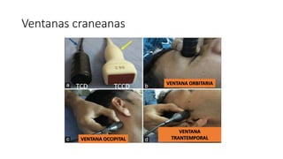 Ventanas craneanas
VENTANA OCCIPITAL
VENTANA ORBITARIA
VENTANA
TRANTEMPORAL
 
