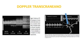 DOPPLER TRANSCRANEANO
 