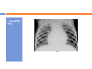 Radioagrafia
em AP
 