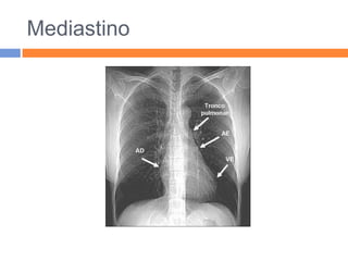 Mediastino
 