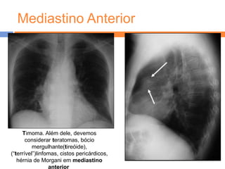 Mediastino Anterior




     Timoma. Além dele, devemos
       considerar teratomas, bócio
          mergulhante(tireóide),
(“terrível”)linfomas, cistos pericárdicos,
   hérnia de Morgani em mediastino
                 anterior.
 
