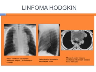LINFOMA HODGKIN
LINFOMA DE HODGKIN




Massa com borda lobulada em                                        Massa de partes moles no
                                       Deslocamento posterior da   mediastino anterior com áreas de
mediastino anterior. LN mediastinais   traquéia pelo tumor
e hilares;                                                         baixa atenuação
 