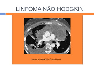 LINFOMA NÃO HODGKIN
   LINFOMA NÃO HODGKIN




      DIFUSO, DE GRANDES CÉLULAS TIPO B
 