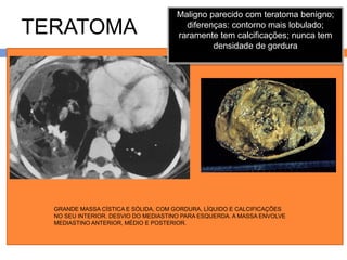 Maligno parecido com teratoma benigno;
TERATOMA                                diferenças: contorno mais lobulado;
                                      raramente tem calcificações; nunca tem
                                               densidade de gordura




  GRANDE MASSA CÍSTICA E SÓLIDA, COM GORDURA, LÍQUIDO E CALCIFICAÇÕES
  NO SEU INTERIOR. DESVIO DO MEDIASTINO PARA ESQUERDA. A MASSA ENVOLVE
  MEDIASTINO ANTERIOR, MÉDIO E POSTERIOR.
 