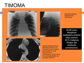 TIMOMA
                                  PEQUENA MASSA
                                  MEDIASTINAL
                                  ANTERIOR




                                    50-60 anos;
                                     Neoplasia
                                 mediastino anterior
                                   mais comum;
                                  30 % malignos
                                    Podem dar
         MASSA ARREDONDADA,          síndrome
         BEM DELIMITADA, EM        compressiva;
         CONTATO COM A AORTA
         ASCENDENTE, COM
         REALCE PELO
         CONTRASTE. ÁREA FOCAL
         DE HIPODENSIDADE NA
         LATERAL DIREITA.
 