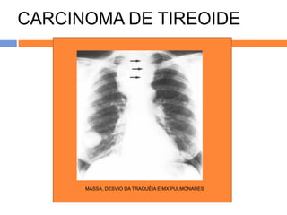 CARCINOMA DE TIREOIDE




      MASSA, DESVIO DA TRAQUÉIA E MX PULMONARES
 
