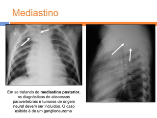 Mediastino




Em se tratando de mediastino posterior,
     os diagnósticos de abscessos
  paravertebrais e tumores de origem
  neural devem ser incluídos. O caso
   exibido é de um ganglioneuroma.
 