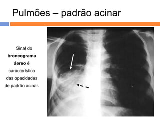 Pulmões – padrão acinar


   O Sinal do
 broncograma
    áereo é
 característico
das opacidades
de padrão acinar.
 