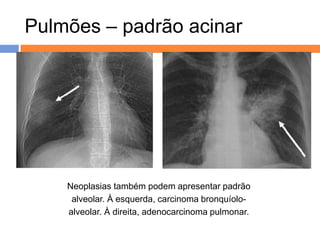 Pulmões – padrão acinar




    Neoplasias também podem apresentar padrão
     alveolar. À esquerda, carcinoma bronquíolo-
    alveolar. À direita, adenocarcinoma pulmonar.
 